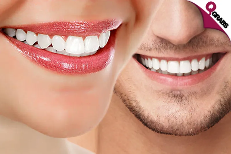 From QR120 Care for your Pearly Whites with Fluoride Treatment OR Teeth Whitening OR Closed Curettage OR Hollywood Smile! (Up to QR3500 Value)